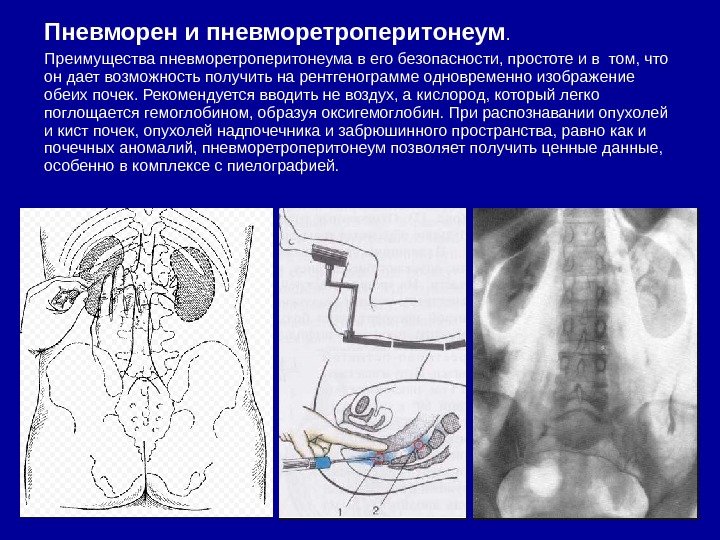 Пневморен и пневморетроперитонеум. Преимущества пневморетроперитонеума в его безопасности, простоте и в том, что он