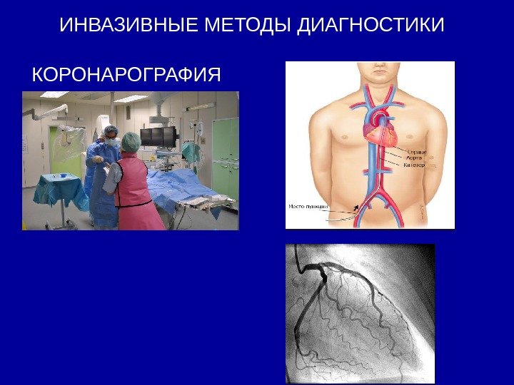  ИНВАЗИВНЫЕ МЕТОДЫ ДИАГНОСТИКИ  КОРОНАРОГРАФИЯ 