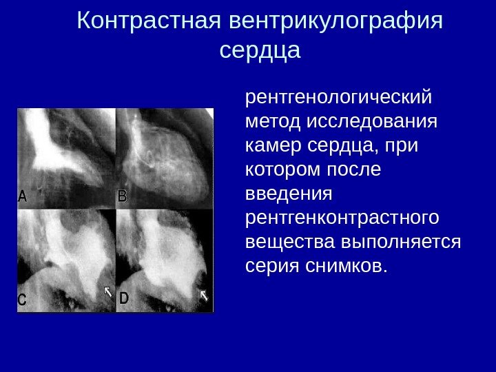 Контрастная вентрикулография сердца рентгенологический метод исследования камер сердца, при котором после введения рентгенконтрастного вещества