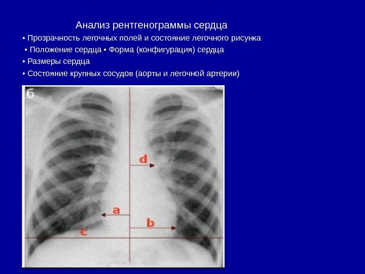     Анализ рентгенограммы сердца  •  Прозрачность легочных полей и