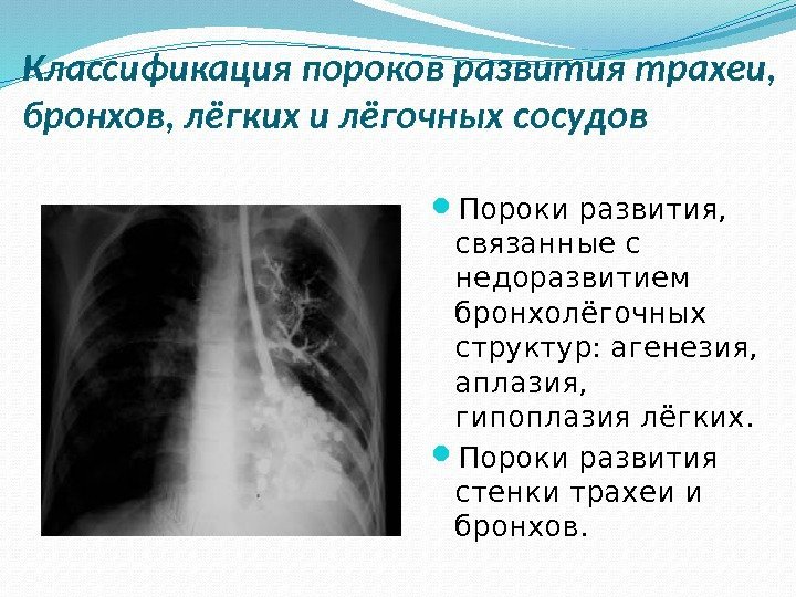  Пороки развития,  связанные с недоразвитием бронхолёгочных структур: агенезия,  аплазия,  гипоплазия