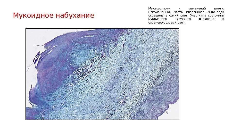 Мукоидное набухание Метахромазия  – изменений цвета.  Неизмененная часть клапанного эндокарда окрашена в