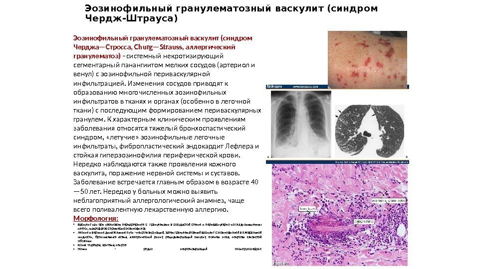 Эозинофильный гранулематозный васкулит (синдром Чердж-Штрауса) Эозинофильный гранулематозный васкулит (синдром Черджа—Стросса, Churg—Strauss, аллергический гранулематоз) –системный