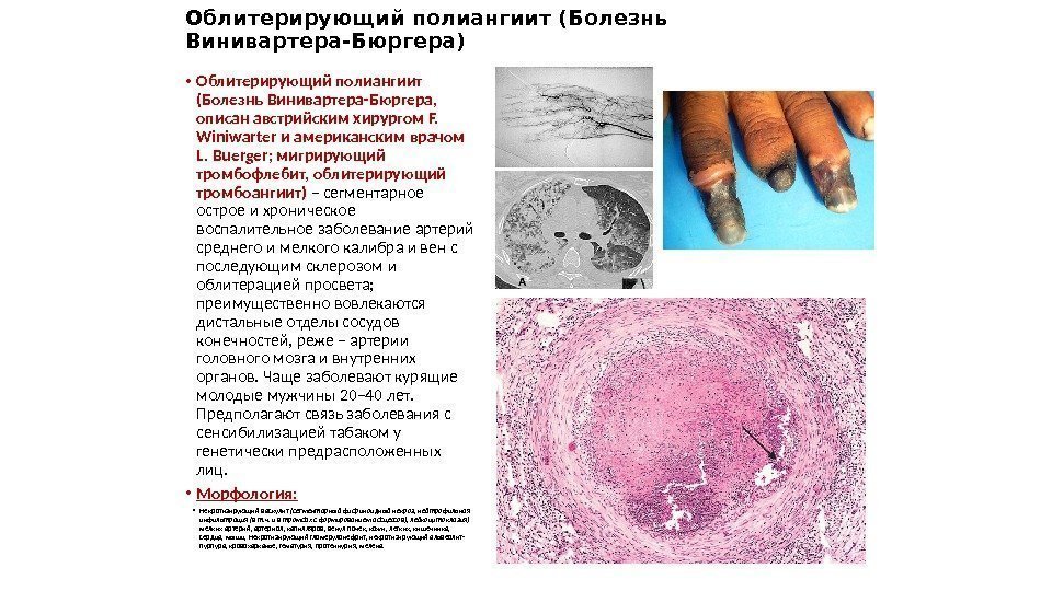 Облитерирующий полиангиит (Болезнь Винивартера-Бюргера) • Облитерирующий полиангиит (Болезнь Винивартера-Бюргера,  описан австрийским хирургом F.