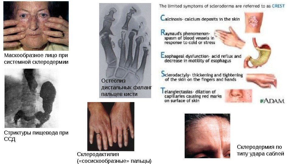 Маскообразное лицо при системной склеродермии Остеолиз дистальных фаланг пальцев кисти Склеродермия по типу удара