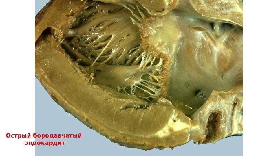 Острый бородавчатый эндокардит 