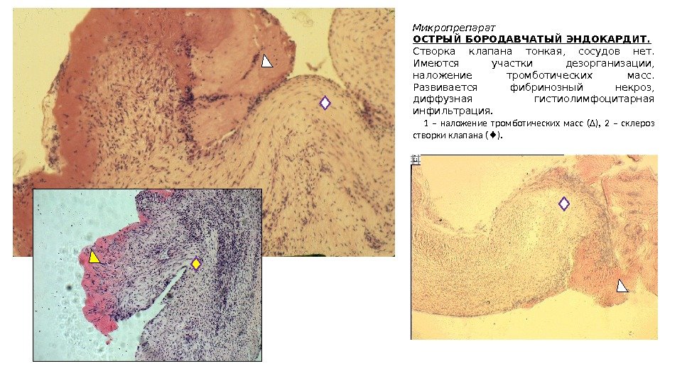 Микропрепарат ОСТРЫЙ БОРОДАВЧАТЫЙ ЭНДОКАРДИТ. Створка клапана тонкая,  сосудов нет.  Имеются участки дезорганизации,