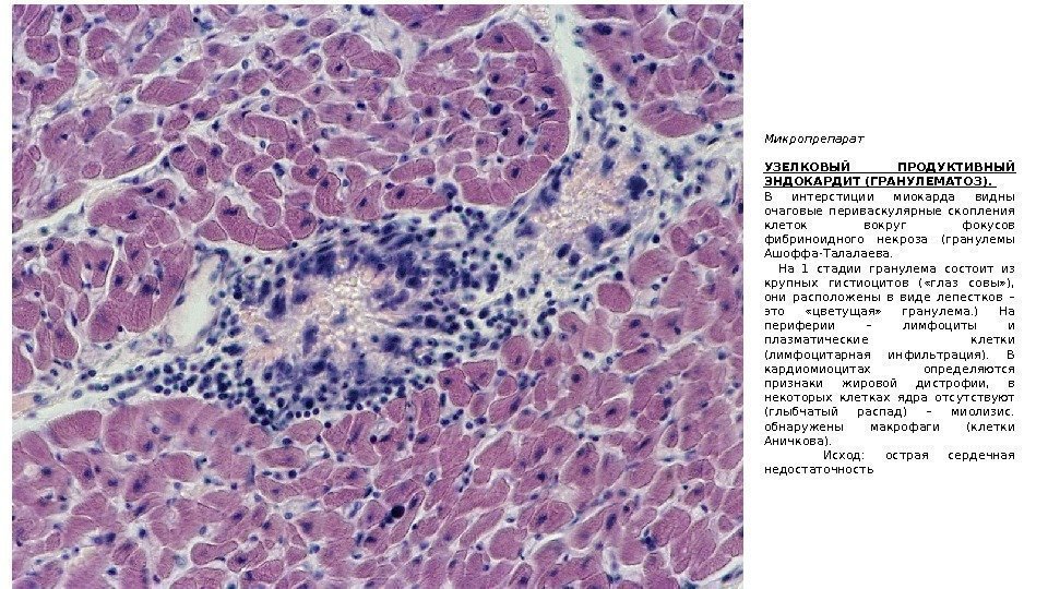 Микропрепарат УЗЕЛКОВЫЙ ПРОДУКТИВНЫЙ ЭНДОКАРДИТ (ГРАНУЛЕМАТОЗ).  В интерстиции миокарда видны очаговые периваскулярные скопления клеток