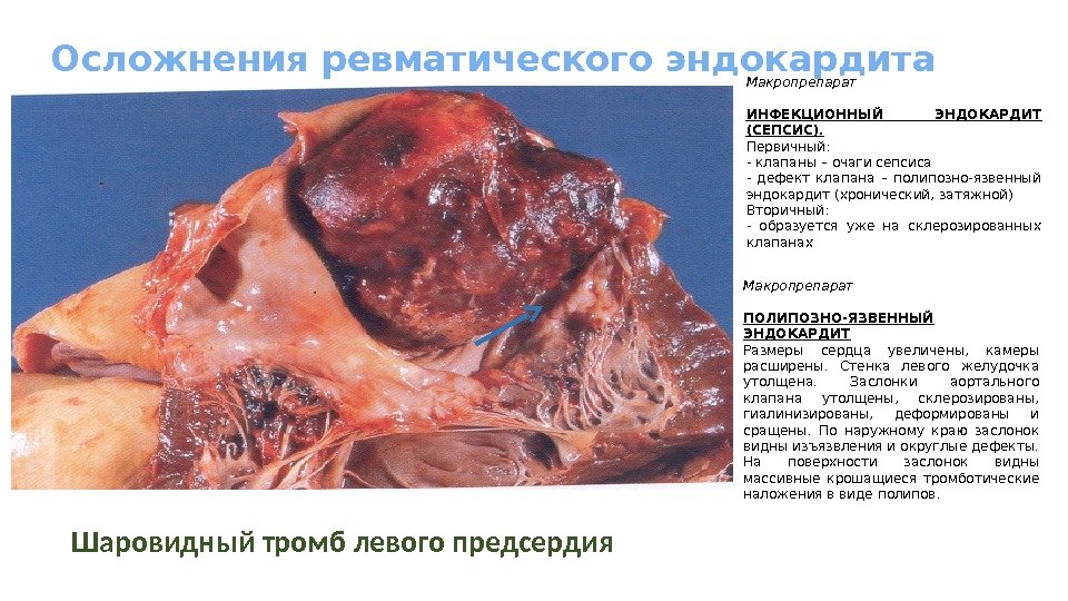 Осложнения ревматического эндокардита Шаровидный тромб левого предсердия Макропрепарат ИНФЕКЦИОННЫЙ ЭНДОКАРДИТ (СЕПСИС). Первичный: - клапаны
