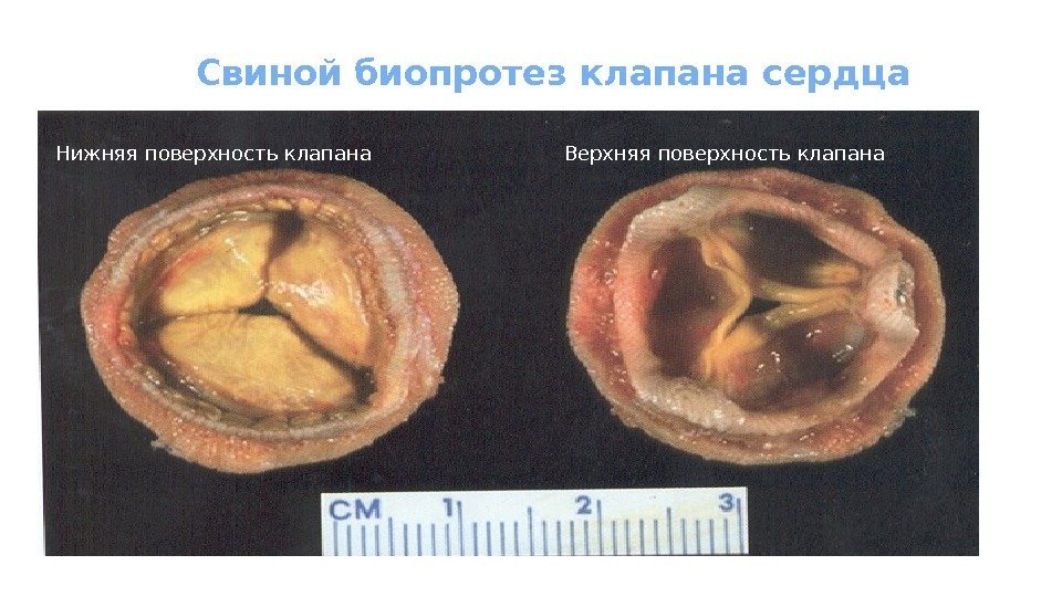 Свиной биопротез клапана сердца Нижняя поверхность клапана Верхняя поверхность клапана 