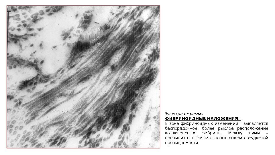 Электронограмма ФИБРИНОИДНЫЕ НАЛОЖЕНИЯ.  В зоне фибриноидных изменений – выявляется беспорядочное,  более рыхлое