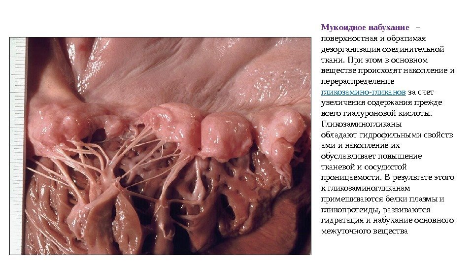 Мукоидное набухание  – поверхностная и обратимая дезорганизация соединительной ткани. При этом в основном