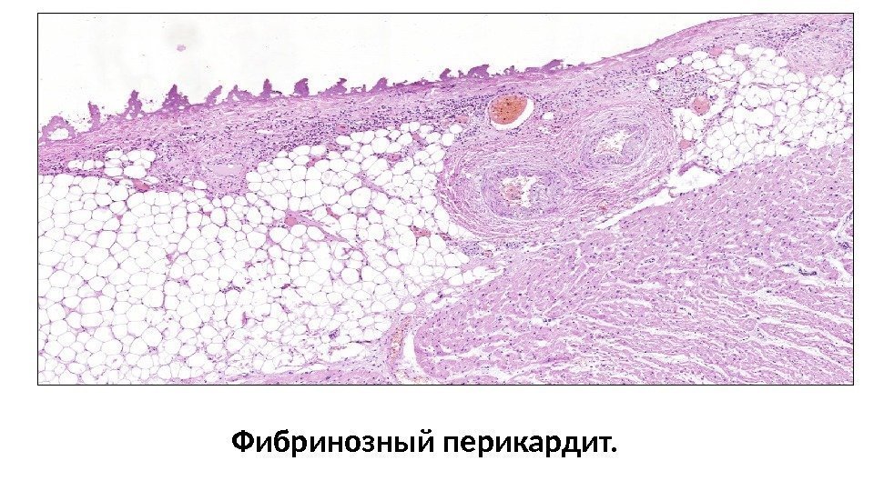   Фибринозный перикардит. 