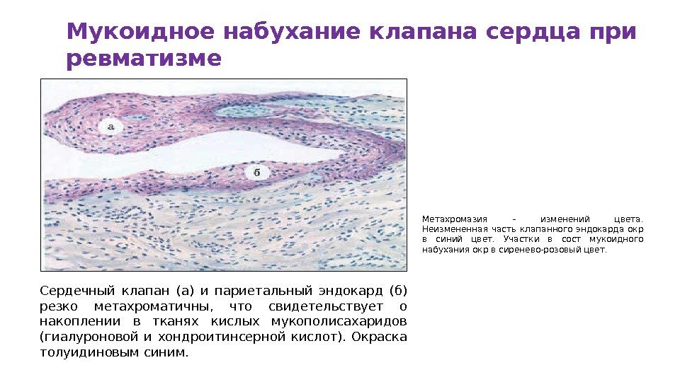 Мукоидное набухание клапана сердца при ревматизме Сердечный клапан (а) и париетальный эндокард (б) резко