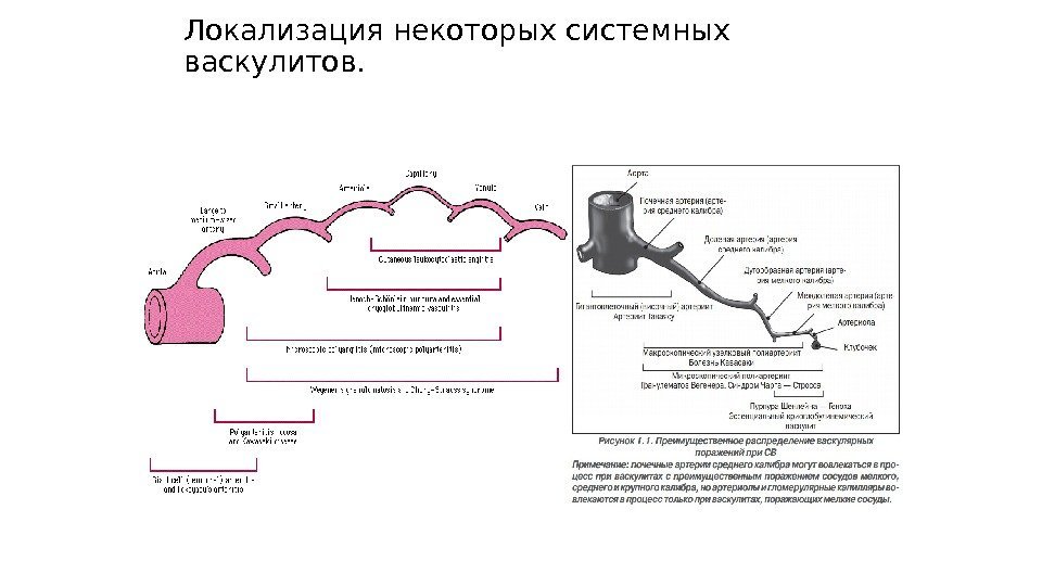 Локализация некоторых системных васкулитов. 