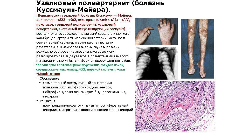 Узелковый полиартериит (болезнь Куссмауля-Мейера).  • Периартериит узелковый (болезнь Куссмауля — Мейера ; 
