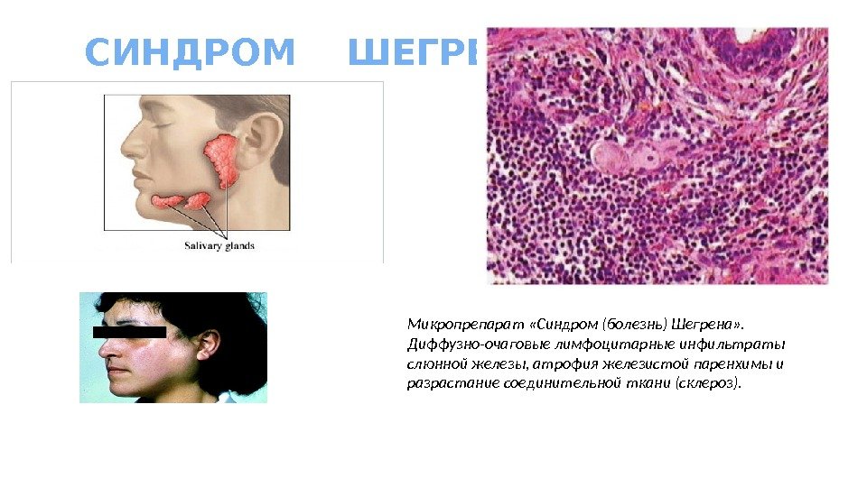 СИНДРОМ  ШЕГРЕНА Микропрепарат «Синдром (болезнь) Шегрена» .  Диффузно-очаговые лимфоцитарные инфильтраты слюнной железы,