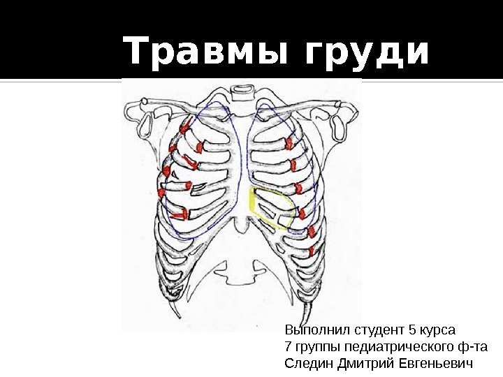 Травмы груди Выполнил студент 5 курса 7 группы педиатрического ф-та Следин Дмитрий Евгеньевич 