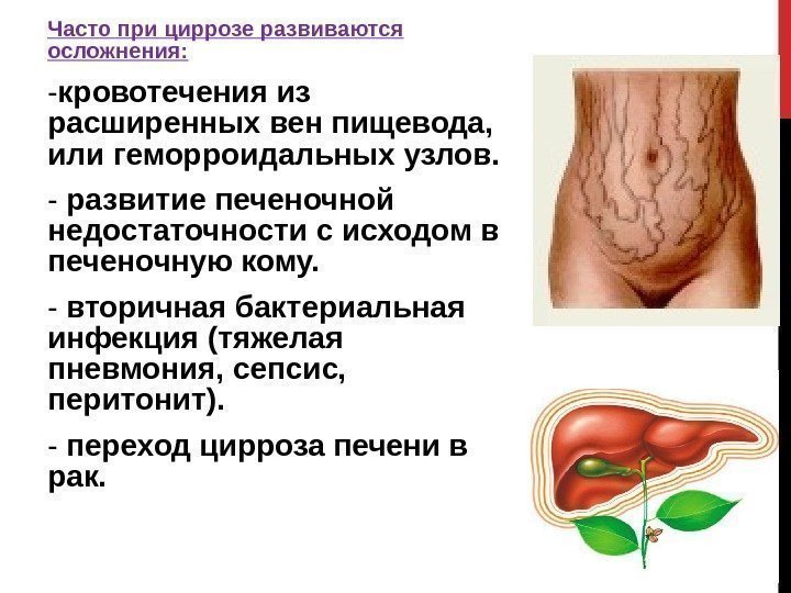 Часто при циррозе развиваются осложнения: - кровотечения из расширенных вен пищевода,  или геморроидальных