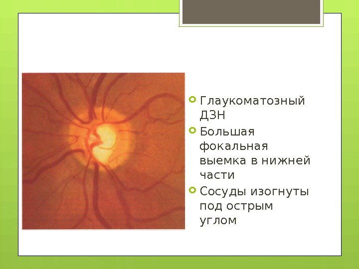  Глаукоматозный ДЗН Большая фокальная выемка в нижней части Сосуды изогнуты под острым углом