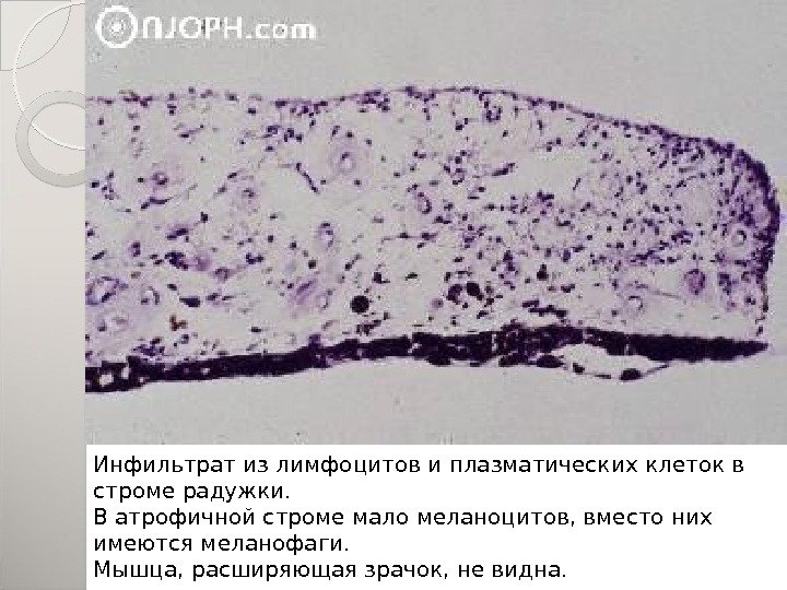 Инфильтрат из лимфоцитов и плазматических клеток в строме радужки.  В атрофичной строме мало