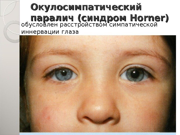 Окулосимпатический паралич (синдром Horner) обусловлен расстройством симпатической иннервации глаза 