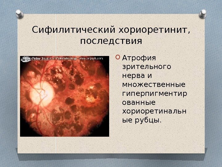 Сифилитический хориоретинит,  последствия O Атрофия зрительного нерва и множественные гиперпигментир ованные хориоретинальн ые