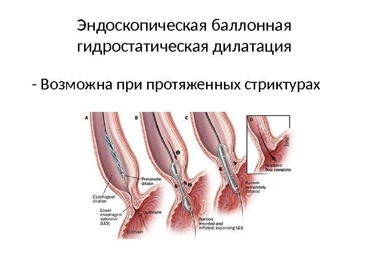 Эндоскопическая баллонная гидростатическая дилатация - Возможна при протяженных стриктурах 