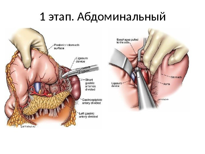 1 этап. Абдоминальный 