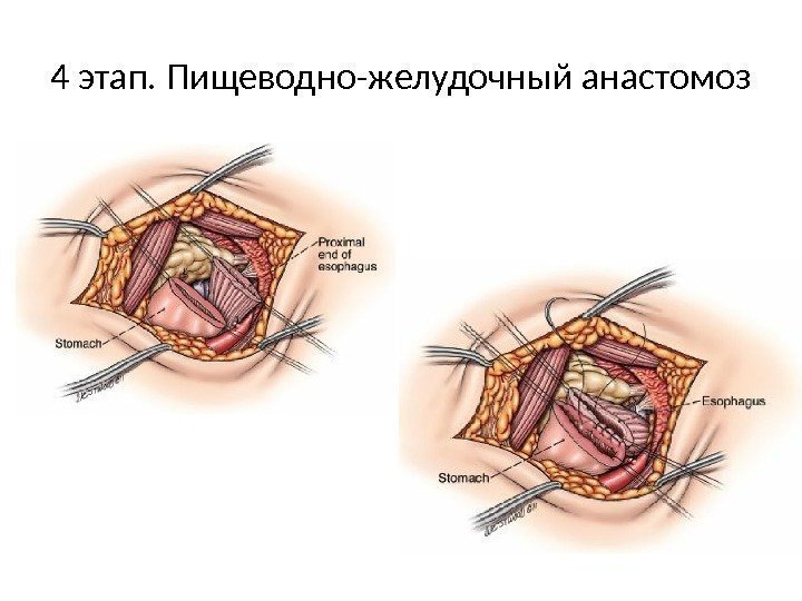 4 этап. Пищеводно-желудочный анастомоз 