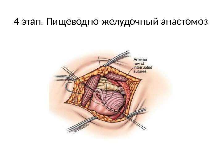 4 этап. Пищеводно-желудочный анастомоз 