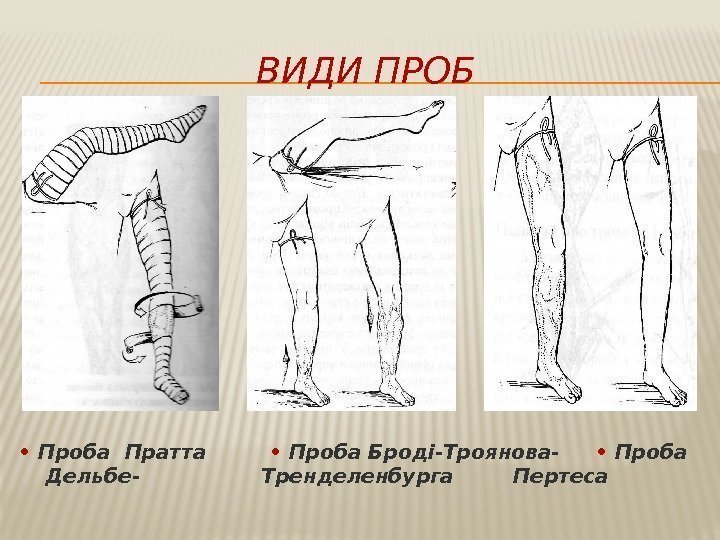 ВИДИ ПРОБ  •  Проба Пратта  •  Проба Броді-Троянова-  •