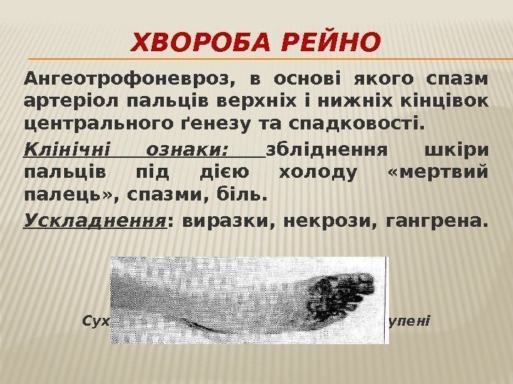 ХВОРОБА РЕЙНО Ангеотрофоневроз,  в основі якого спазм артеріол пальців верхніх і нижніх кінцівок