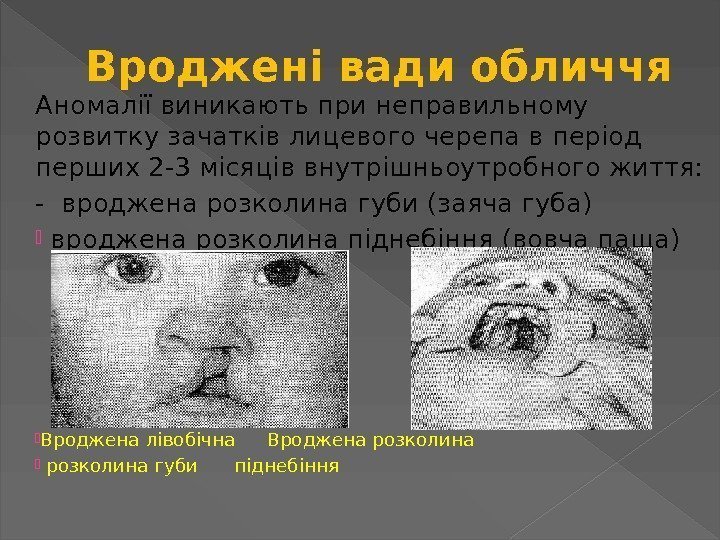 Вроджені вади обличчя Аномалії виникають при неправильному розвитку зачатків лицевого черепа в період перших