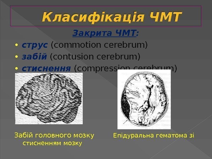 Класифікація ЧМТ Закрита ЧМТ :  •  струс (commotion cerebrum) •  забій