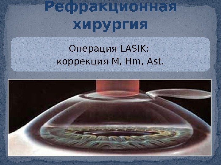 Операция LASIK:  коррекция М, Hm, Ast. Рефракционная хирургия 0 C 04 14 