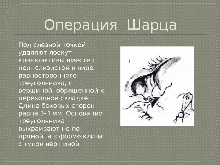 Операция Шарца Под слезной точкой удаляют лоскут конъюнктивы вместе с под- слизистой в виде