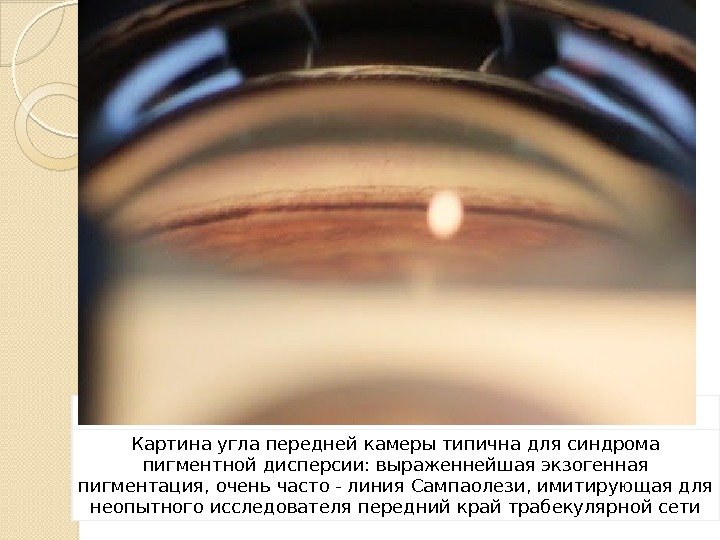 Картина угла передней камеры типична для синдрома пигментной дисперсии: выраженнейшая экзогенная пигментация, очень часто