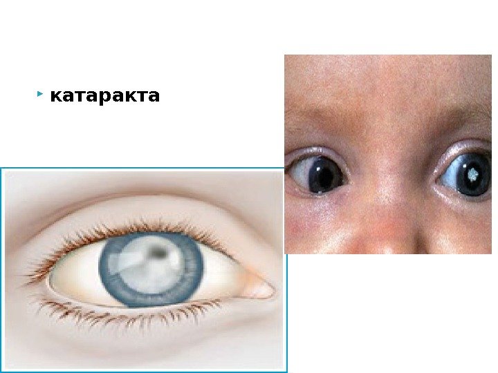  катаракта  