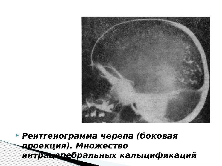  Рентгенограмма черепа (боковая проекция). Множество интрацеребральных калыцификаций 