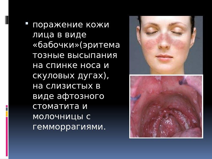  поражение кожи лица в виде  «бабочки» (эритема тозные высыпания на спинке носа
