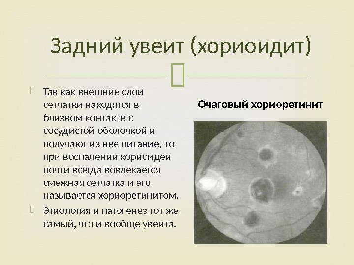  Задний увеит (хориоидит) Так как внешние слои сетчатки находятся в близком контакте с