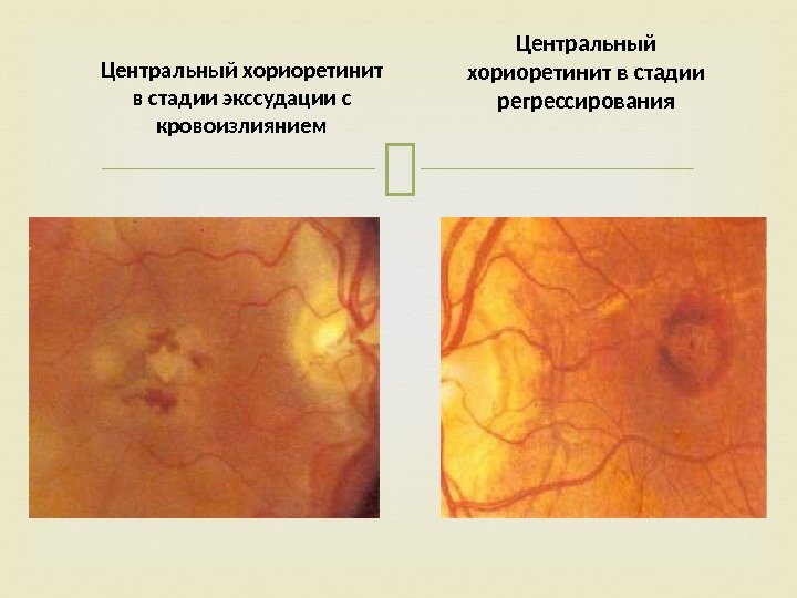 Центральный хориоретинит в стадии экссудации с кровоизлиянием Центральный хориоретинит в стадии регрессирования 