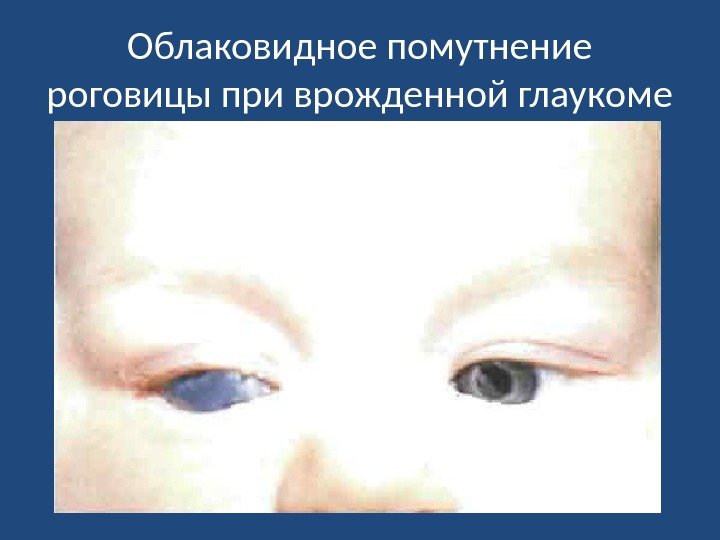 Облаковидное помутнение роговицы при врожденной глаукоме 