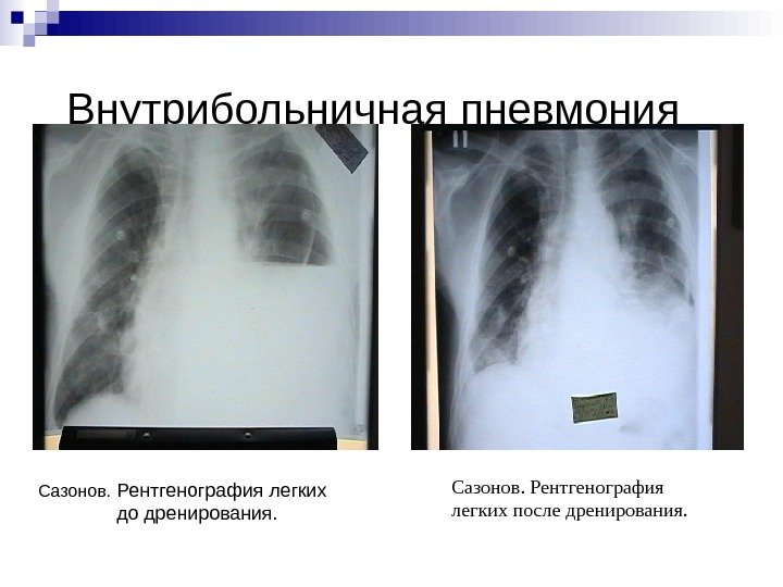 Внутрибольничная пневмония Сазонов.  Рентгенография легких до дренирования. Сазонов. Рентгенография легких после дренирования. 