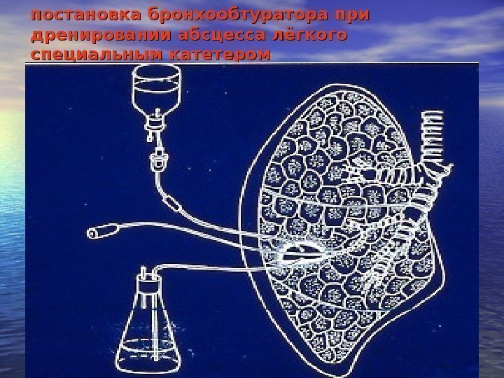   постановка бронхообтуратора при дренировании абсцесса лёгкого  специальным катетером 