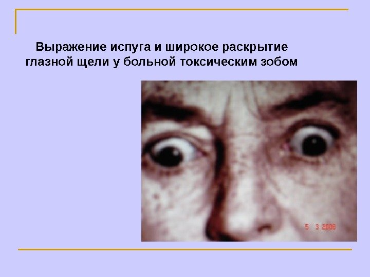   Выражение испуга и широкое раскрытие глазной щели у больной токсическим зобом 