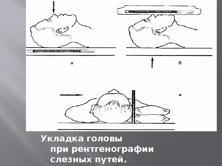 Укладка головы прирентгенографии слезныхпутей. 