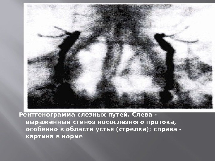  Рентгенограмма слезных путей. Слева - выраженный стеноз носослезного протока,  особенно в области