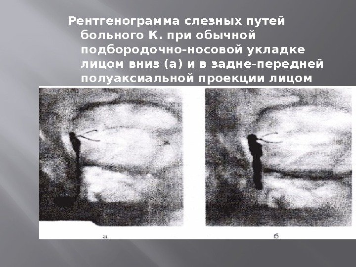  Рентгенограмма слезных путей больного К. при обычной подбородочно-носовой укладке лицом вниз (а) и
